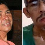 José antes e depois do aparecimento do tumor