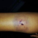 Mordida causou hematoma e vítima foi medicada no Hospital Regional / Imagens: Jornal da Nova
