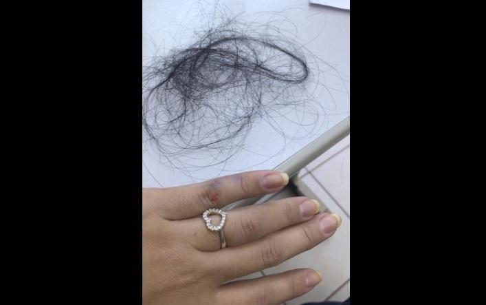 Tufo de cabelo e o dedo da enfermeira machucado (Via WhatsApp)
