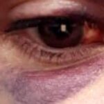 Mulher teve hematomas no joelho e ombro