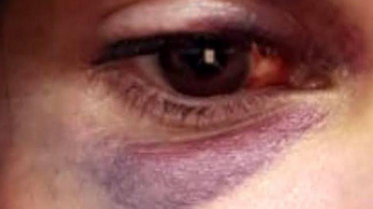 Mulher teve hematomas no joelho e ombro