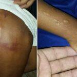 Menino tinha vários hematomas no corpo. Foto: Folha MS.