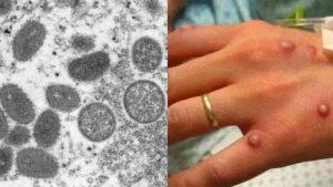 monkeypox