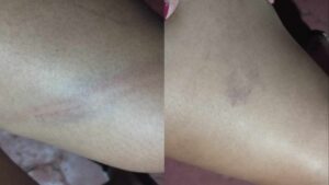 hematomas