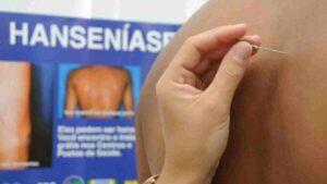 Hanseníase