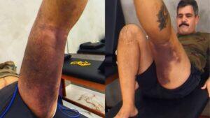 operado juliano cazarre hematomas perna