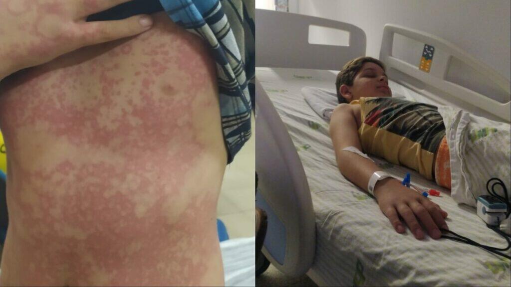 alergia