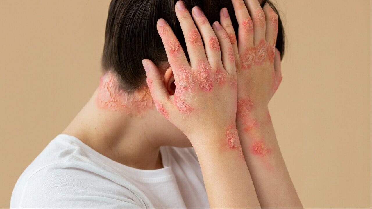 alergia