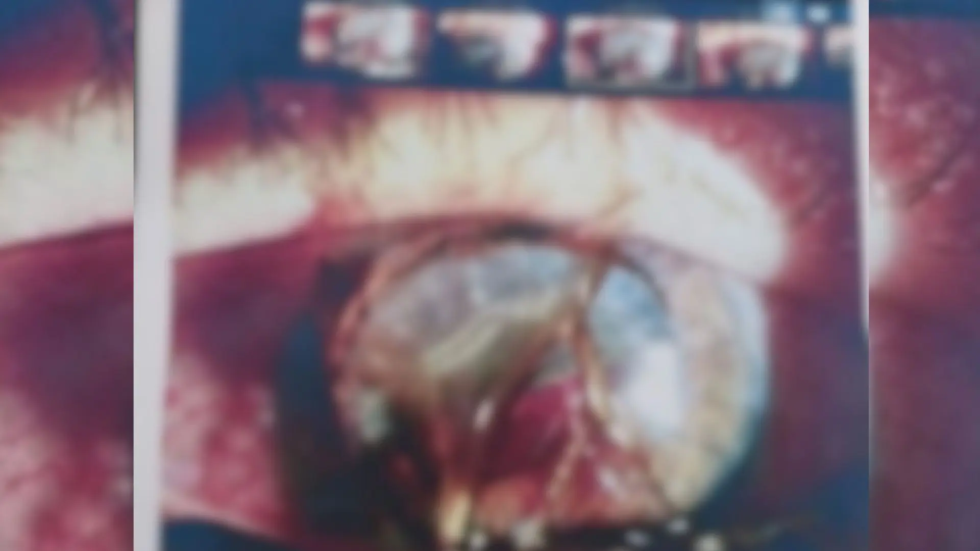 Paciente agredido por andarilho teve córnea ‘rasgada’ e terá dano permanente na visão