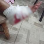 À espera de vaga em hospital, idosa corre risco de perder o pé após acidente em Camapuã