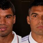 CASEMIRO PLASTICA RINOPLASTIA