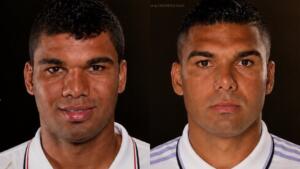 CASEMIRO PLASTICA RINOPLASTIA