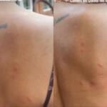 Jakelyne leva ‘ataque’ de mosquitos em Campo Grande e mostra marcas das picadas