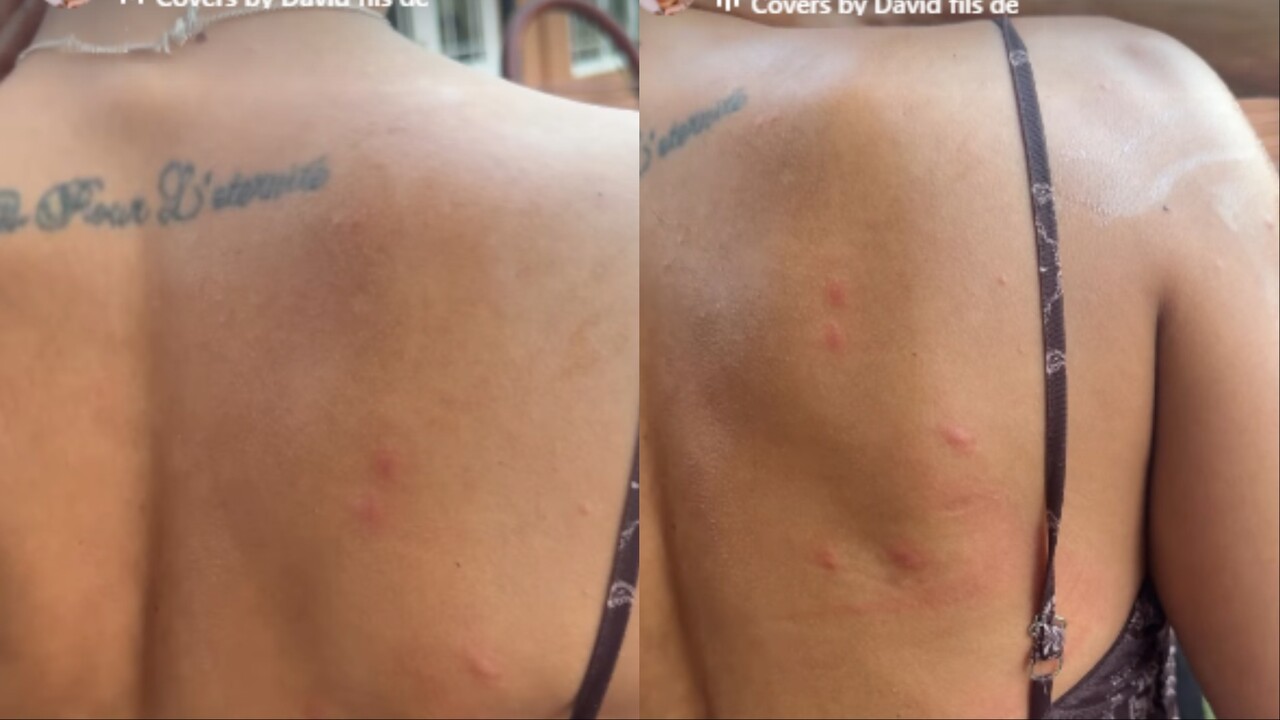 Jakelyne leva ‘ataque’ de mosquitos em Campo Grande e mostra marcas das picadas