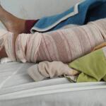 Derrubada de moto durante assalto, professora sofreu várias fraturas e espera vaga para cirurgia