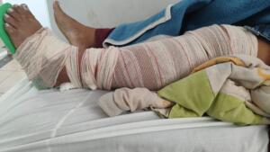 Derrubada de moto durante assalto, professora sofreu várias fraturas e espera vaga para cirurgia