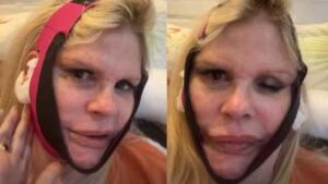 Monique Evans surge irreconhecível após cirurgia plástica: ‘O olho não fecha’