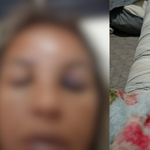 Atropelada por engano em conveniência no Aero Rancho ficará um mês sem andar